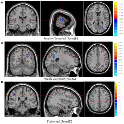 Sex Differences in Cerebral Blood Flow and Serum Inflammatory Cytokines and Their Relationships in Mild Traumatic Brain Injury